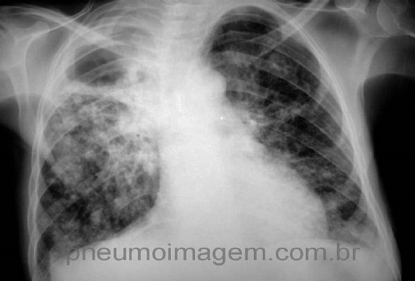 INDISPONIBILIDADE DE PPD PARA REALIZAÇÃO DO TESTE TUBERCULÍNICO NO BRASIL INDISPONIBILIDADE DE PPD PARA REALIZAÇÃO DO TESTE TUBERCULÍNICO NO BRASIL